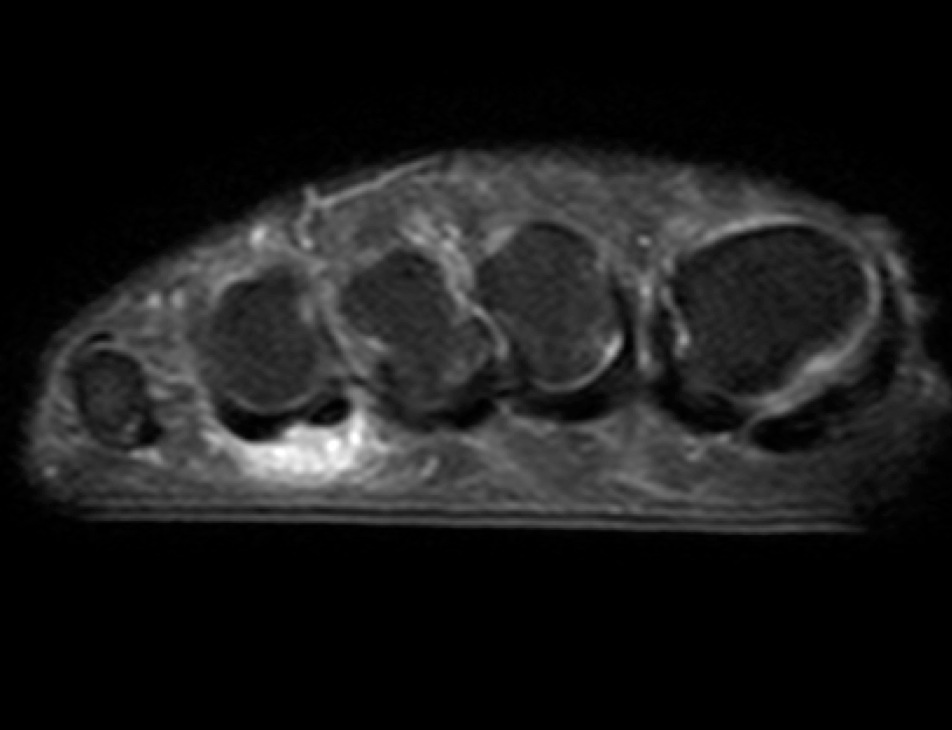 Figure 5 for case Advential bursitis